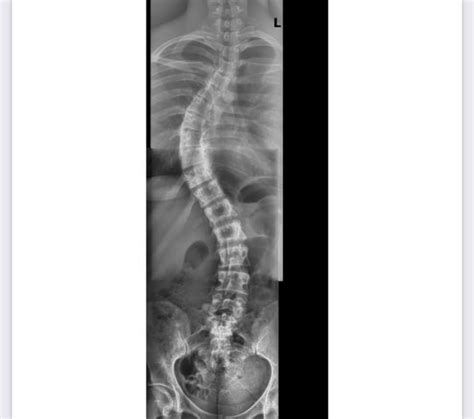 Myofascial Pain Thoracic Lumbar Scoliosis Scapular Winging Right Shoulder R Scoliosis