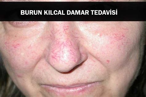 Burun Kılcal Damar Tedavisi Dr Okan DOST