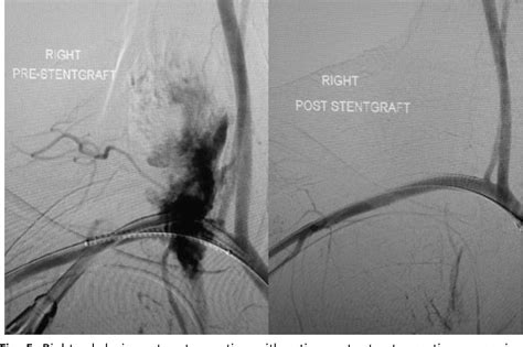 Figure 5 From Management Of Major Vascular Injuries Neck Extremities And Other Things That