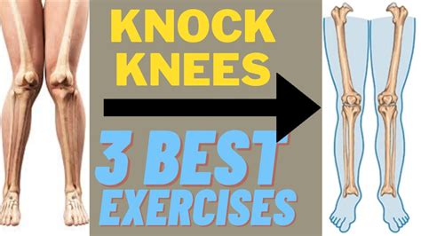 3 Best Exercises For Knock Knees Hip Strengthening Exercises For Knock