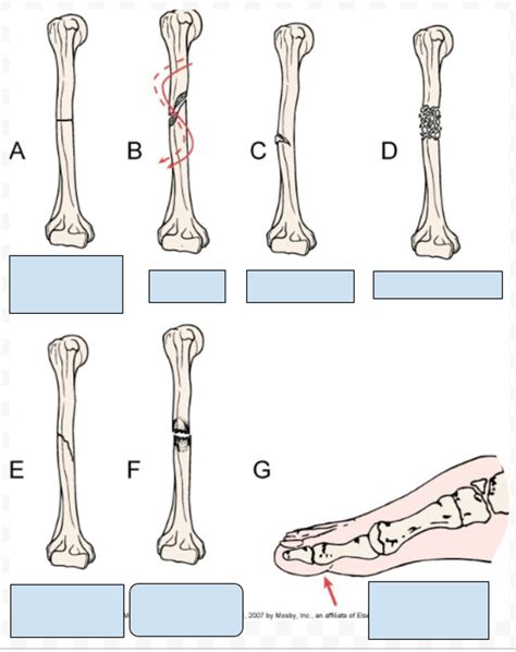 Types Of Fractures Diagram Quizlet