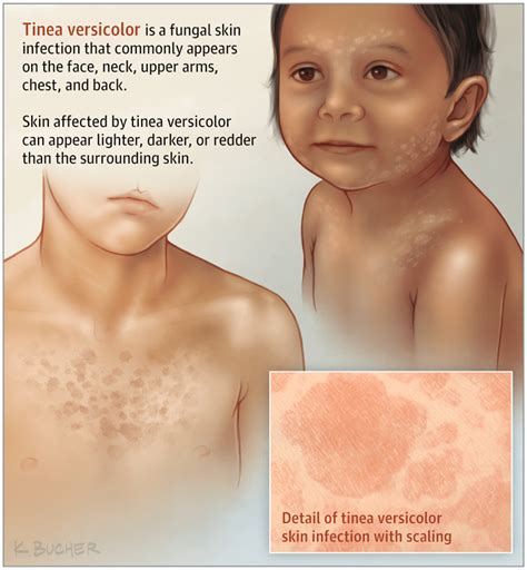 Tinea Versicolor Know More About It By Dr Radhika Amulraj Lybrate