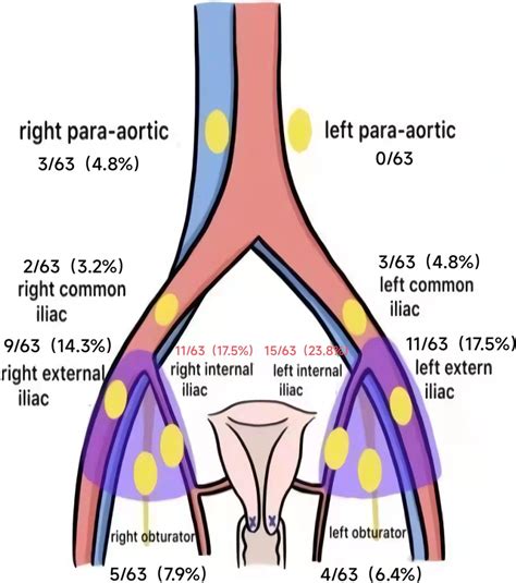 Distribution pattern of pelvic and abdominal sentinel lymph nodes ...