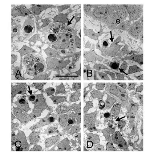 Transmission Electron Microscopy Tem To Reveal Apoptotic Debris And