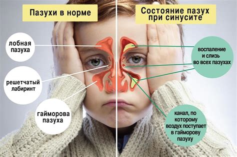Может ли гайморит быть без насморка и и заложенности носа