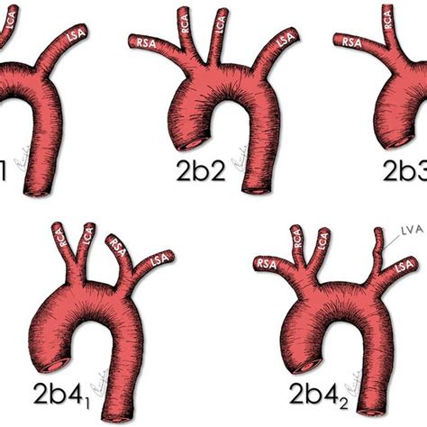 Four Subtypes With 5 Branches Arsa Aberrant Right Subclavian Artery