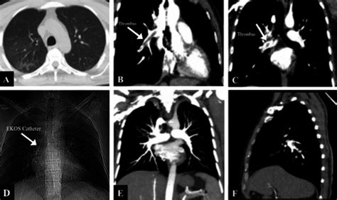 Treatment With EkoSonic Endovascular System EKOS Of Massive