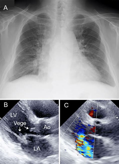 Figure1 Chest X Ray A And A Transthoracic Parasternal Long Axis