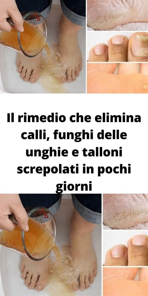 Il Rimedio Che Elimina Calli Funghi Delle Unghie E Talloni Screpolati