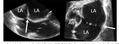 Endoscopic Repair Of Obstructive Cor Triatriatum Semantic Scholar