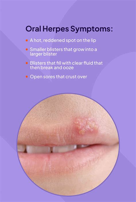 Cold Sore On Lower Lip