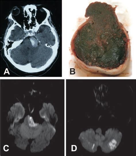 Thrombosis And Stroke In Dolichoectasia A Axial Ct Angiogram