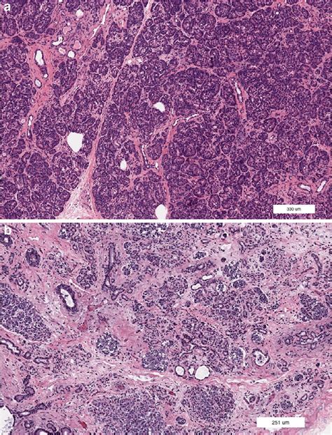 Inter And Intralobular Fibrosis Of The Exocrine Pancreas A Pancreas