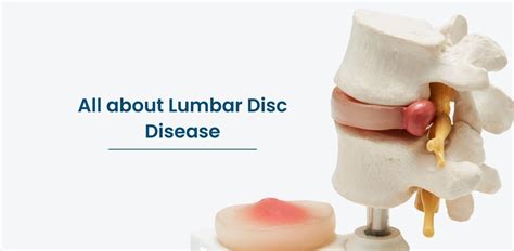 All About Lumbar Disc Disease