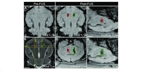 Spatial Correlation Of Ultrafast D Microbubble Cavitation With