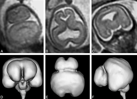 Holoprosencephaly Mri