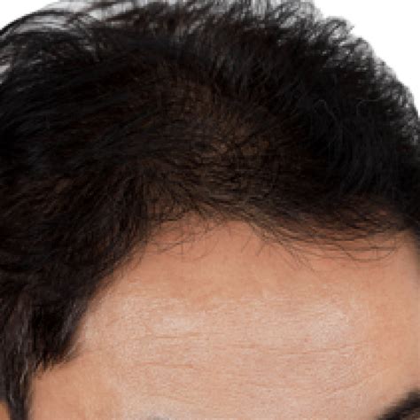 Prp Scalp 1 Buckhead Hair Restoration