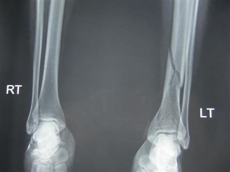 Tibial Plafond Fractures Trauma Orthobullets