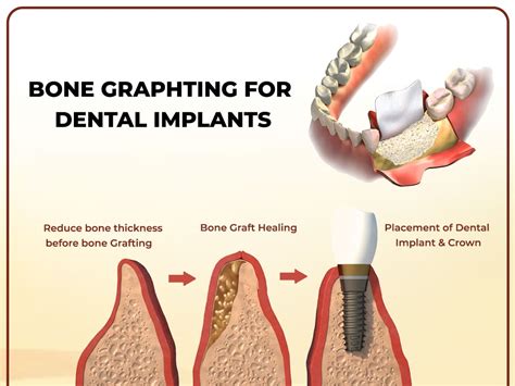 Building A Strong Foundation The Crucial Role Of Bone Grafting In