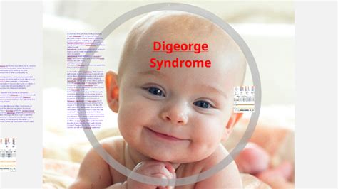 Digeorge Syndrome By Jonry Solis On Prezi