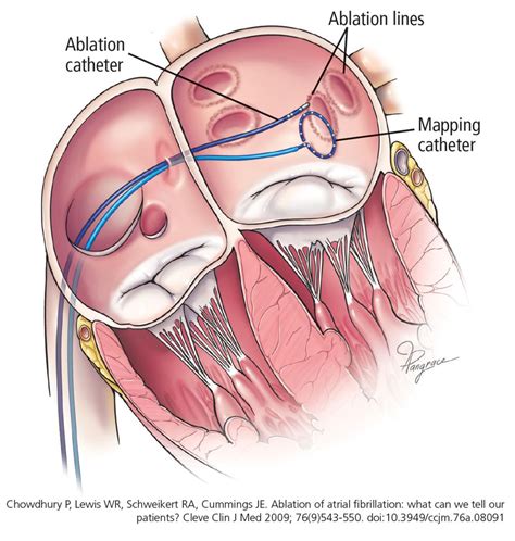 Ablation Of Atrial Fibrillation Facts For The Referring Physician