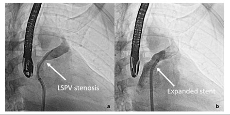 Figure 2 From Percutaneous Pulmonary Vein Stenting To Treat Severe Pulmonary Vein Stenosis After