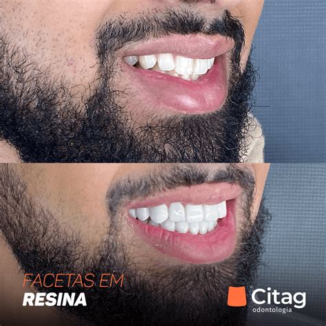 citag facetas