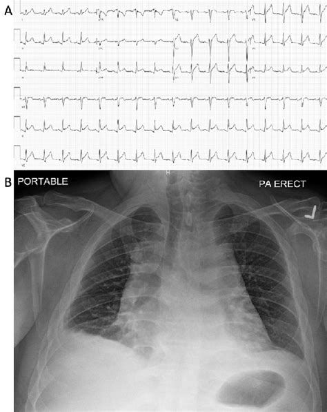 A Lead Electrocardiogram Showing Widespread St Elevations And Pr