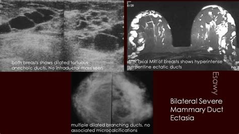 Breast duct ectasia us mammogram mri