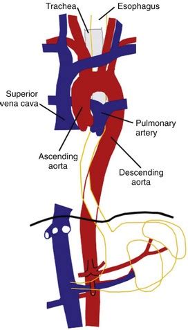 Diseases Of The Aorta Thoracic Key