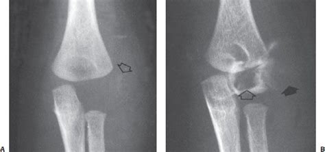 Lateral Condylar And Capitellar Fractures Of The Distal Humerus Musculoskeletal Key