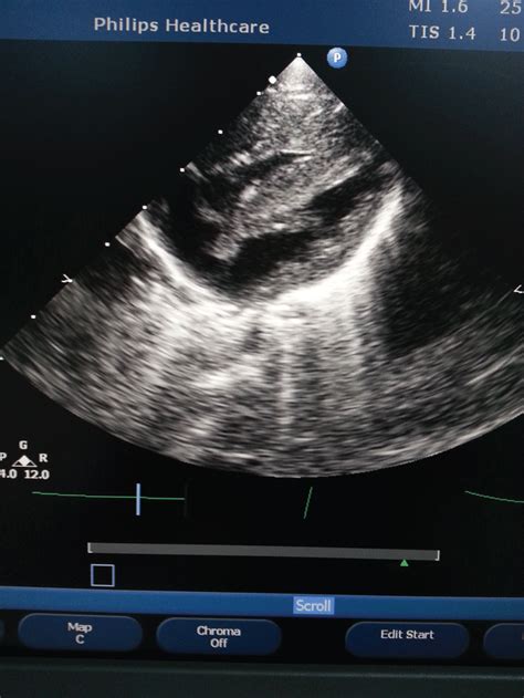 Clinmed International Library Transient Isolated Right Ventricular