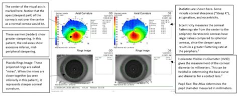 Moran Core A Brief Overview Of Keratoconus And Its Topographical Findings