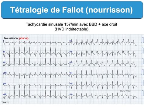 T Tralogie De Fallot E Cardiogram