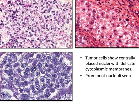 Germ Cell Tumors Of Ovary Ppt