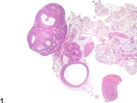 Ovary - Mesonephric Duct Remnant - Nonneoplastic Lesion Atlas