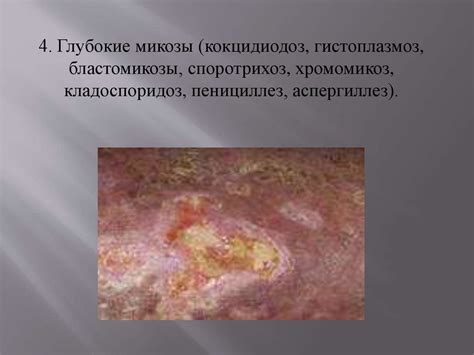 Микозы. Возбудители. Этиология, классификация, клиника - презентация онлайн