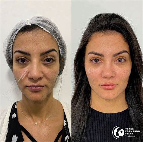 Harmonização Facial ANTES E DEPOIS Procedimentos esteticos