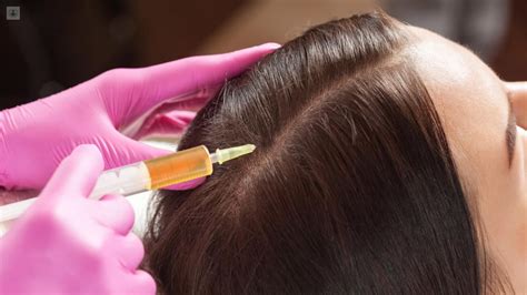 Plasma Rico En Plaquetas Como Tratamiento Para La Alopecia Top Doctors