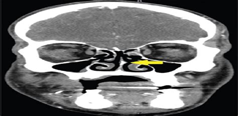 Nasal Spur Causing Permanent Damage To Intubating Video Bron