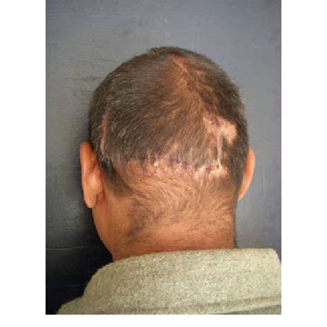 (PDF) Reconstruction of a Large Posterior Scalp Defect Using Occipital ...