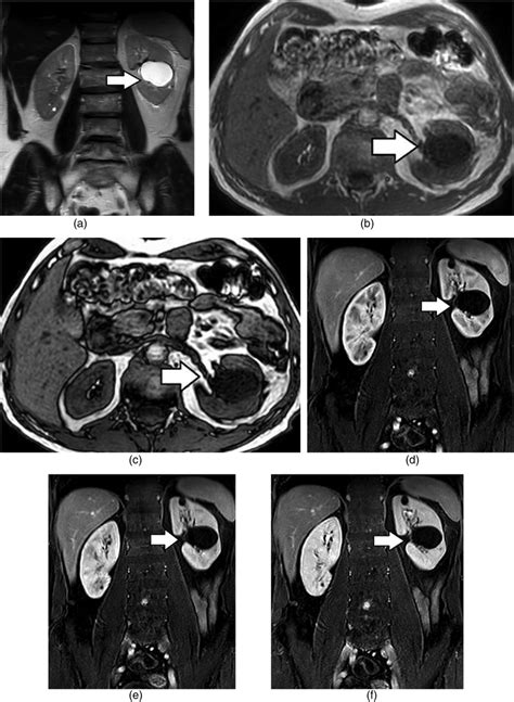 Renal MRI protocol should include: (a) coronal T2W, axial (b) in-phase... | Download Scientific ...