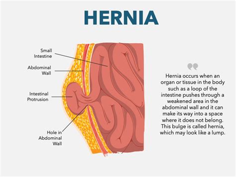 Hernia Powerpoint And Google Slides Template Ppt Slides