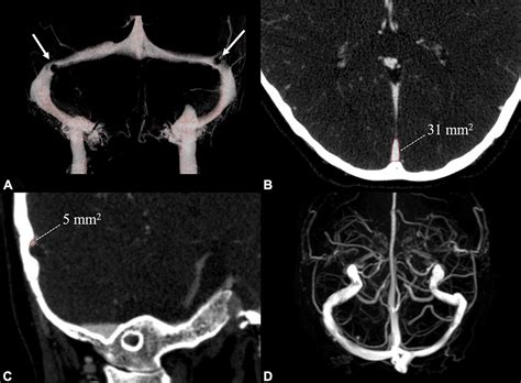 Frontiers Transverse Sinus Stenosis In Venous Pulsatile Tinnitus