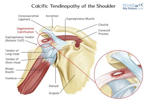 Calcification in your shoulder – shockwave can help | The Body Refinery