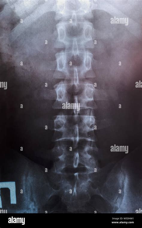 X Ray Of The Lumbar Spine Spine On X Ray Stock Photo Alamy