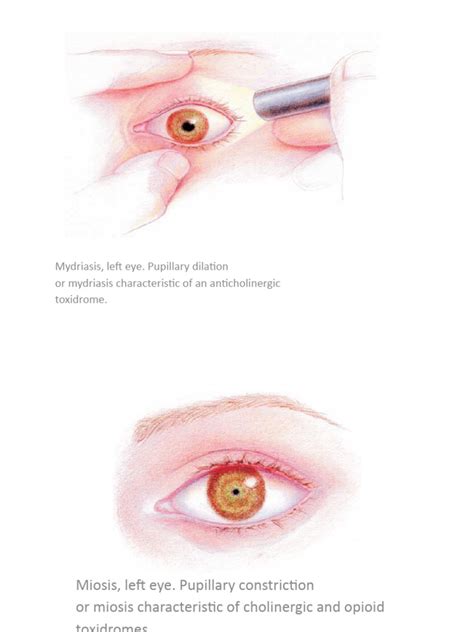 Mydriasis And Miosis 1 Pdf
