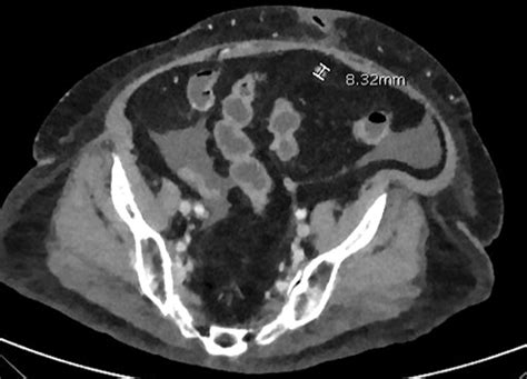 Complications After Liver Transplant Related To Preexisting Conditions Diagnosis Treatment