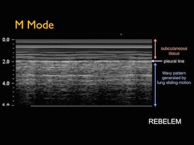 Picture Of Pneumothorax M Mode Ultrasound