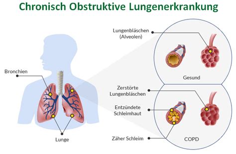 Chronisch Obstruktive Lungenerkrankung Erkaltung Ratgeber